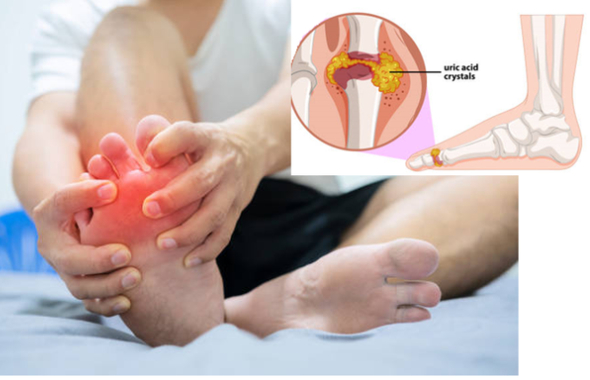 Sữa có tác dụng làm giảm triệu chứng gout không?
